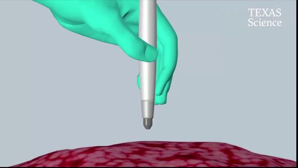 Pen Identifies Cancer In 10 Seconds