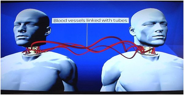 World’s First Head Transplant A Success